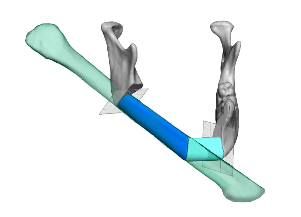 VSP Reconstruction Mandible with Fibula_Render.