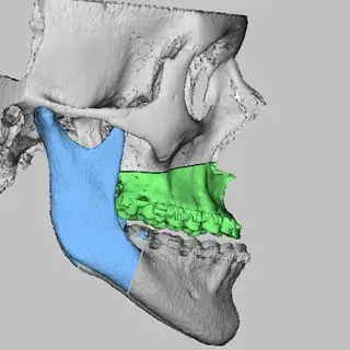 vsp orthognathics accurate osteotomy simulation