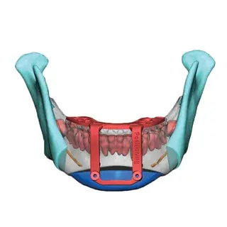 vsp orthognathics genio pos guide front blue chin