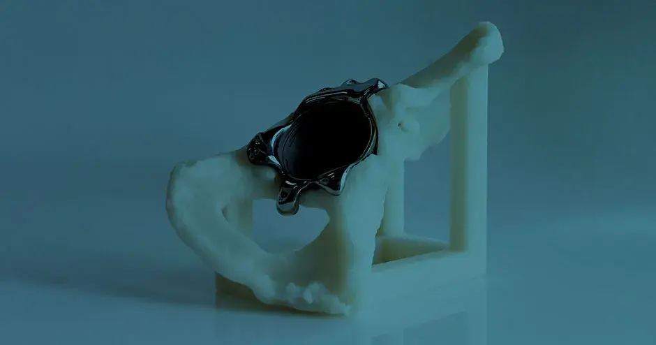 Modelo médico en metal impreso en 3D