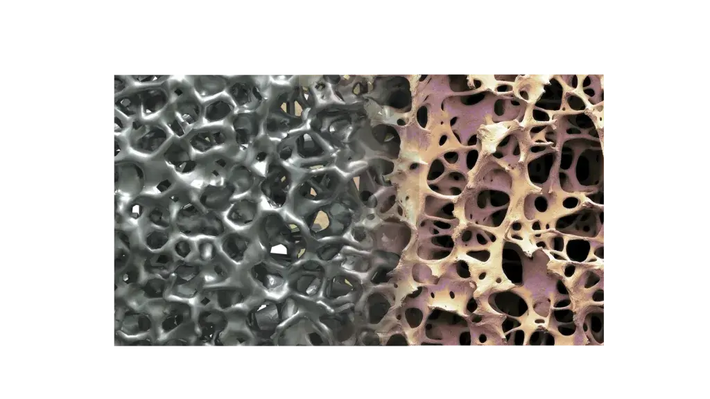 El diseño de la línea de implantes espinales Modulus de NuVasive está pensado para mejorar los resultados clínicos de los pacientes con implantes espinales.