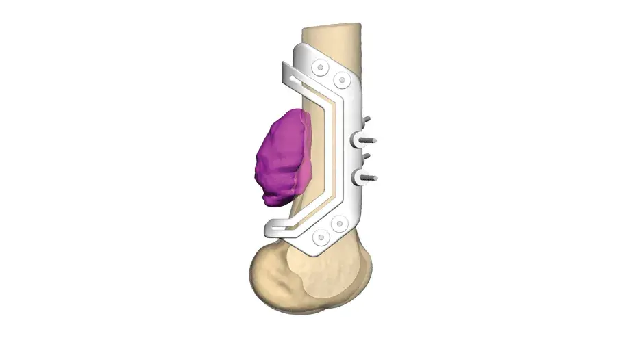 3d-systems-healthcare-vsp-orthopaedics-distal-femur-resection-instrument