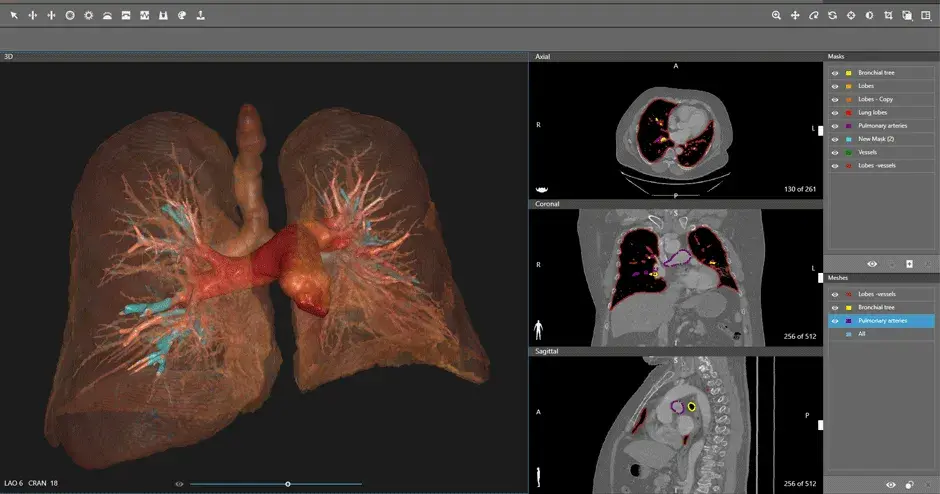 Imagen de los pulmones con D2P