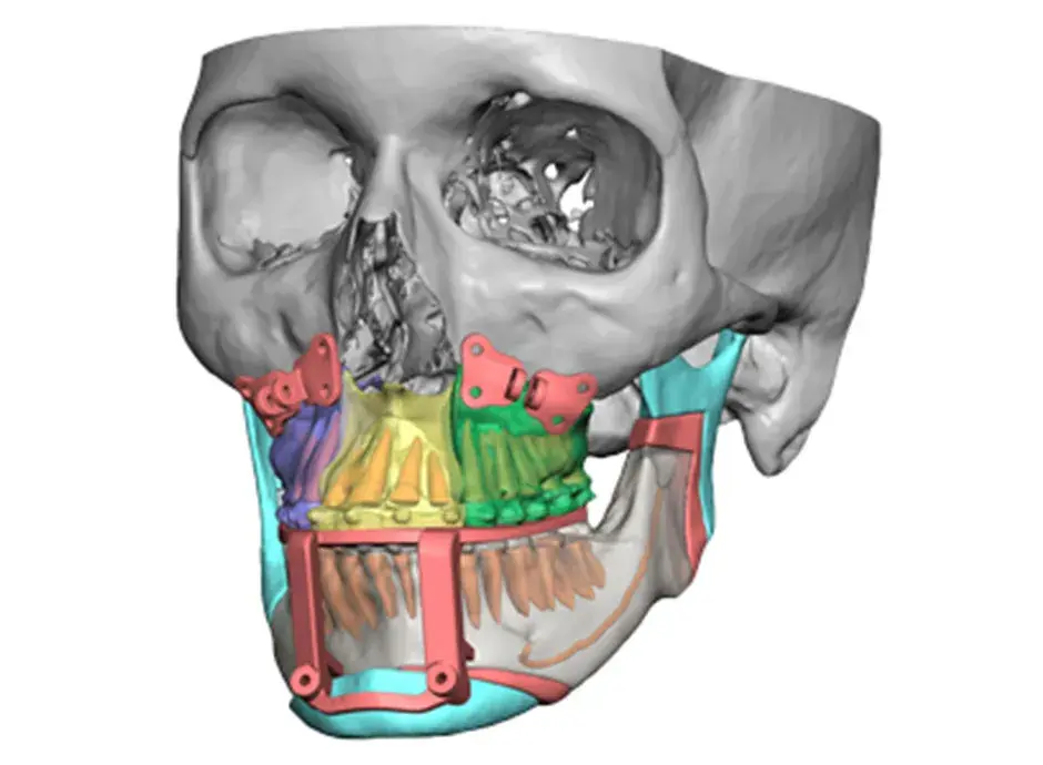 vsp orthognathics positioning iso