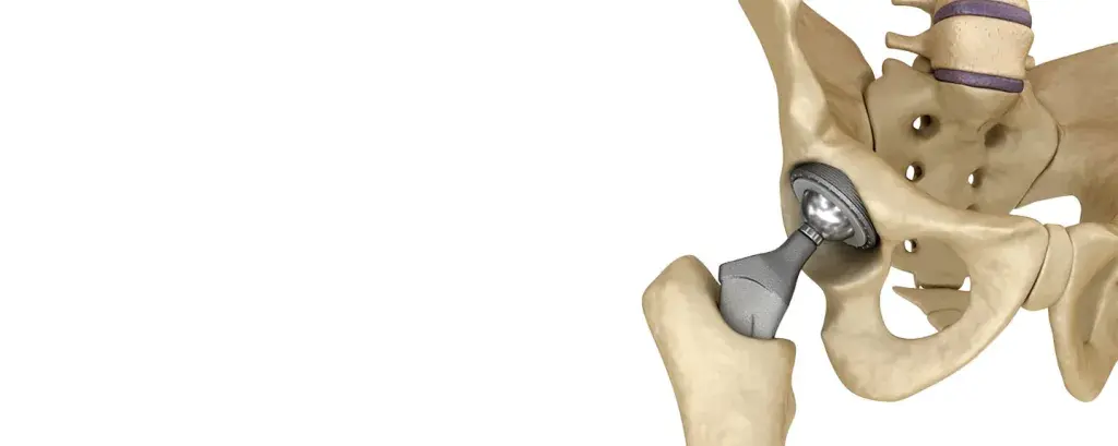 Hip cup and femoral implant rendering on hip model