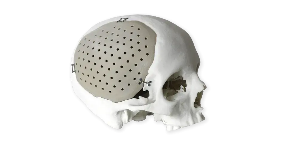 Implantes craneales PEEK
