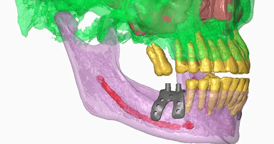 Implantes dentales de Graft3D