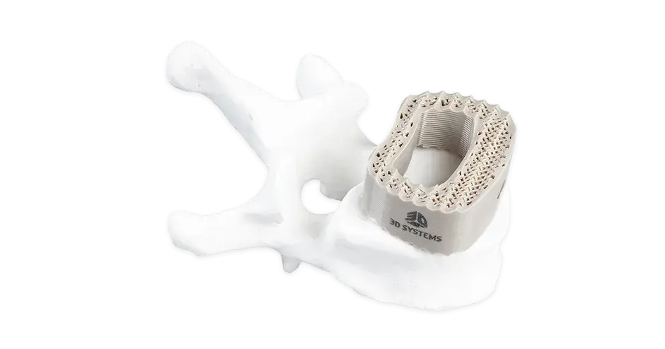 Jaula espinal impresa en 3D PEEK